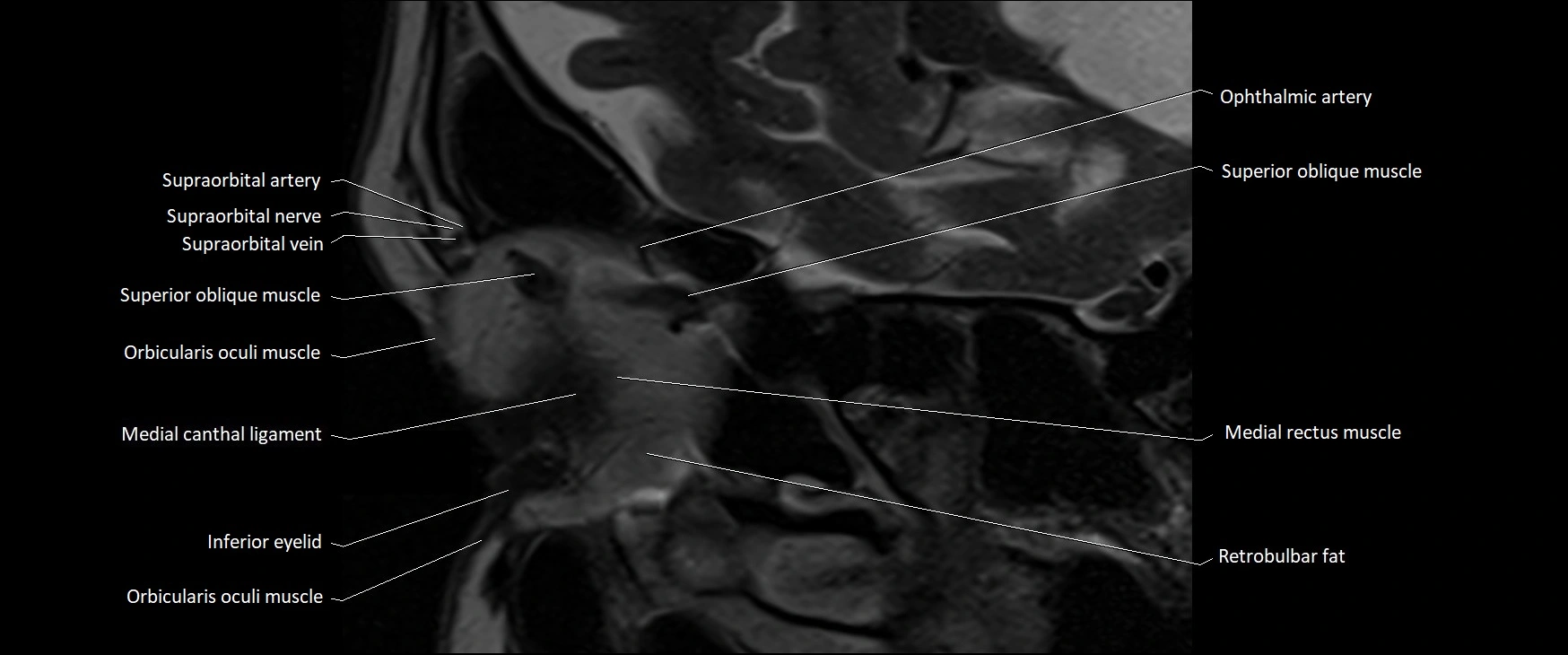 MRI Orbit sagittal cross sectional anatomy 3T image 3.webp